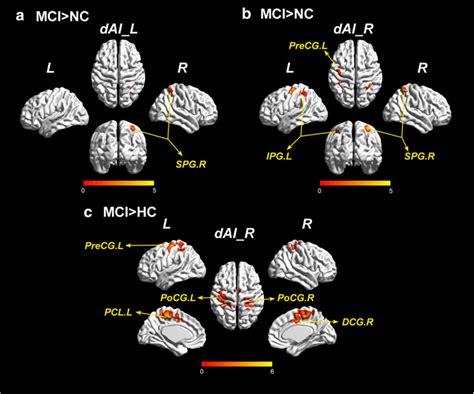 Brain Regions That Have Significant Differences Between Two Groups A A