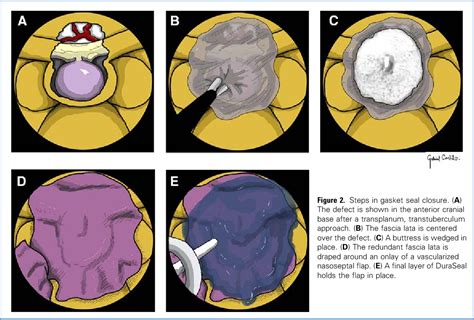 Figure 2 From Gasket Seal Closure For Extended Endonasal Endoscopic