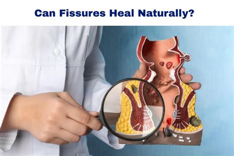 Do Anal Fissures Heal On Their Own Causes Healing