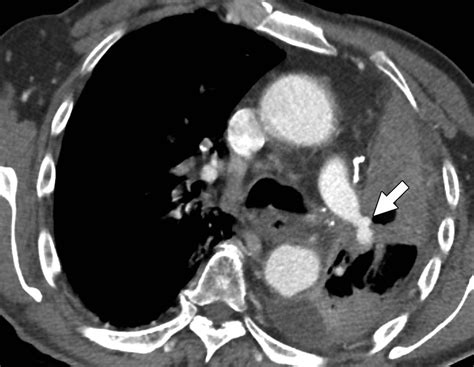 Pulmonary Artery Pseudoaneurysms Clinical Features And Ct Findings Ajr