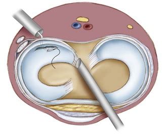 Arthroscopic Meniscus Repair All Inside Technique Musculoskeletal Key