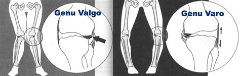 Genu Varo Causas Diagnóstico Y Tratamiento