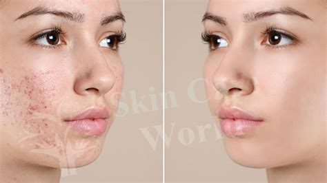 Acne Surgery In Gurgaon Dr Savita Yadav