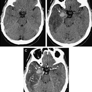 Hemorrhagic CMV encephalitis. T1W axial image ( A ) shows bilateral ...