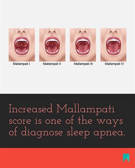 Mallampati score is simple and fast method for assessing upper airway ...