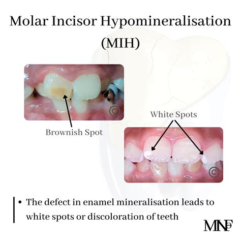 Molar Incisor Hypomineralisation Mih Smile Specialists