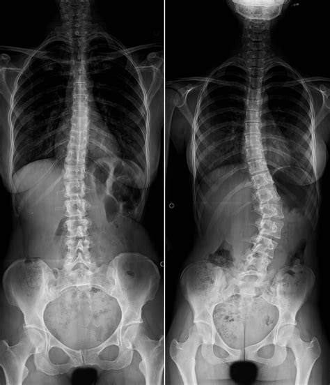 Escoliose Consultório Quiroprático Girona