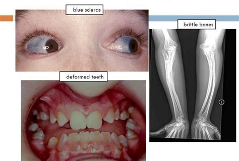 Osteogenesis Imperfecta Clinical Features Types Radiographic The Best