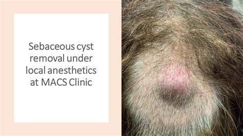 Excision Of Sebaceous Cyst Under Local Anaesthetics By Mr Shailesh