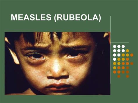 Measles Theory Ppt