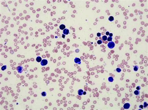 Peripheral smear normocytic, normochromic anemia with ovalocytes and an ...