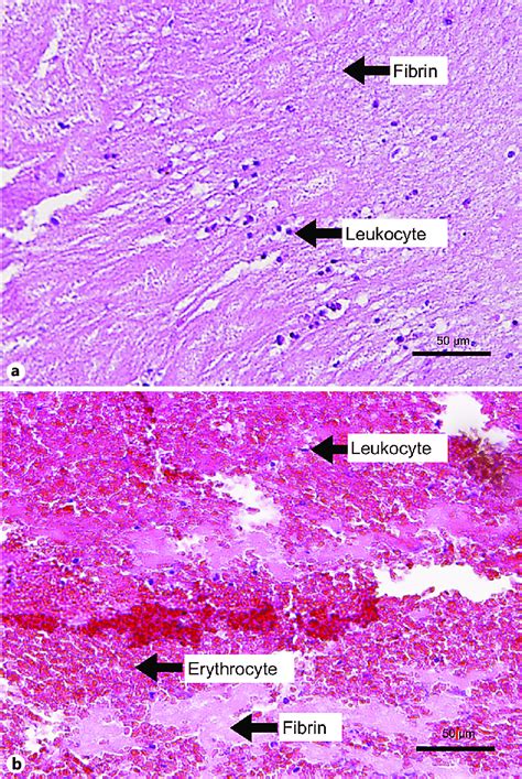 Fibrin Histology