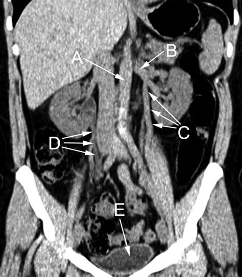 Ct Of Abdomen Without Contrast