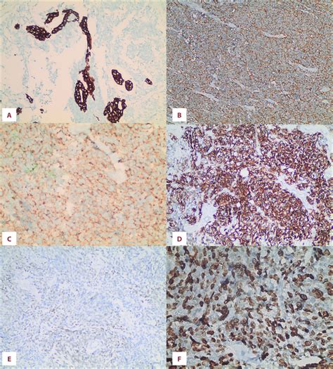 Immunohistochemical Stains Of The Left Breast Tumor A The Tumor Shows