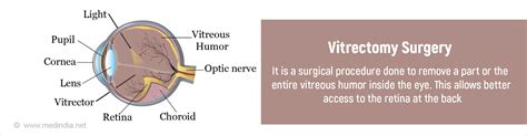 Vitrectomy Surgery Types Indications Procedure And Complications