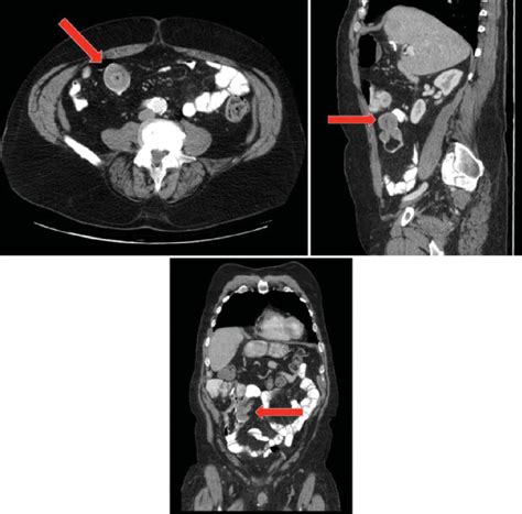 Ileoileal Adult Intussusception With Classic Bulls Eye Appearance Download Scientific Diagram