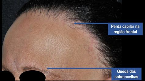 Alopecia Frontal Fibrosante Sinais Causas E Tratamento Transplante