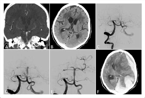 An 80 Year Old Female Patient With Acute Basilar Artery Occlusion