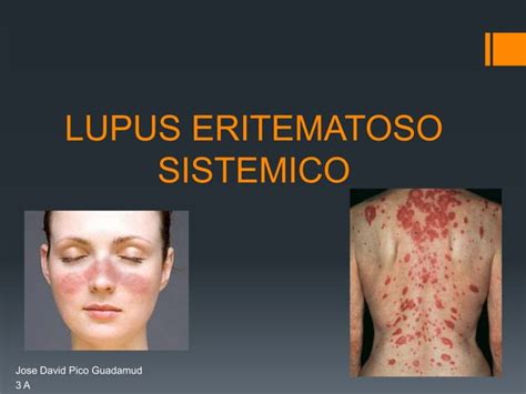 Lupus Eritematoso Sistemico Ppt Descarga Gratuita