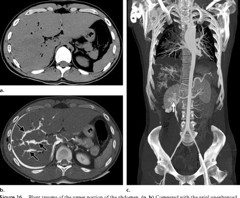 Figure From Postmortem Ct Angiography Capabilities And Limitations