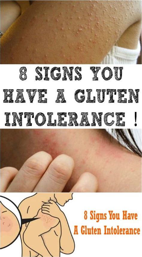 Signs You Have A Gluten Intolerance Gluten Intolerance Symptoms