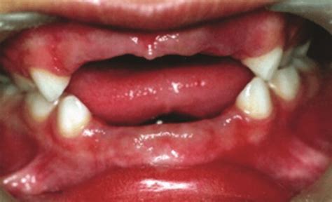 Extraction Of Involved Primary Teeth I E 62 Download Scientific Diagram