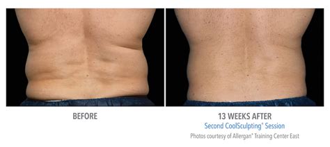 Coolsculpting For Men Non Surgical Fat Reduction Reduce Beer Belly