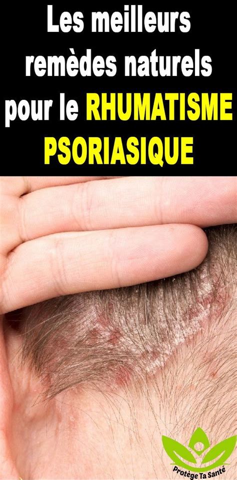 Les Meilleurs Rem Des Naturels Pour Le Rhumatisme Psoriasique