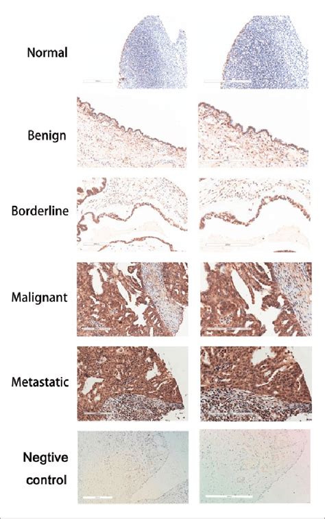 Immunohistochemical Analysis Of ROR2 Expression In Normal Ovarian