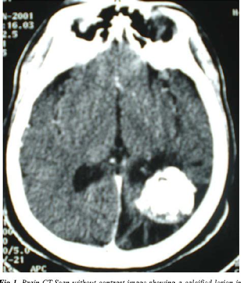 Figure 1 From Intracranial Calcified Hydatid Cyst Mimicking Primary