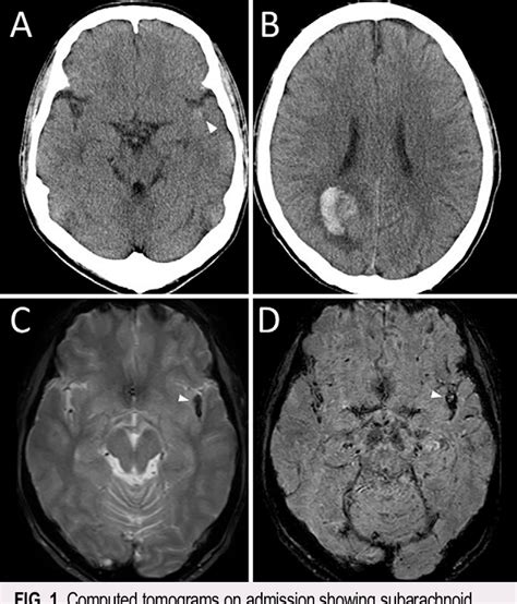 Figure 1 From Simultaneous Intracerebral And Subarachnoid Hemorrhages