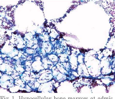 Figure From Acute Promyelocytic Leukemia Presenting Initially With