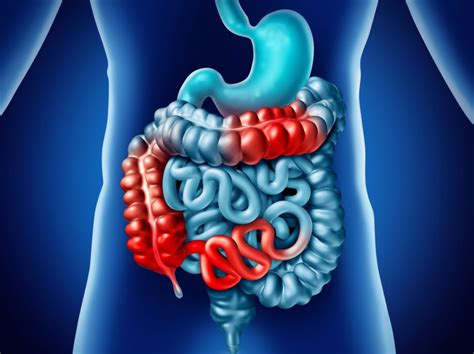 Subcutaneous Vedolizumab Safe And Effective For Crohn Disease