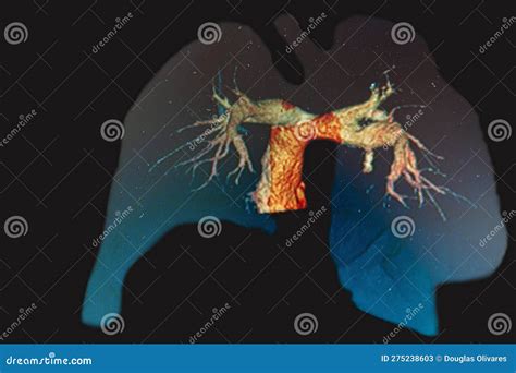 Pulmonary Artery Ct Angiography Stock Image Image Of Respiratory