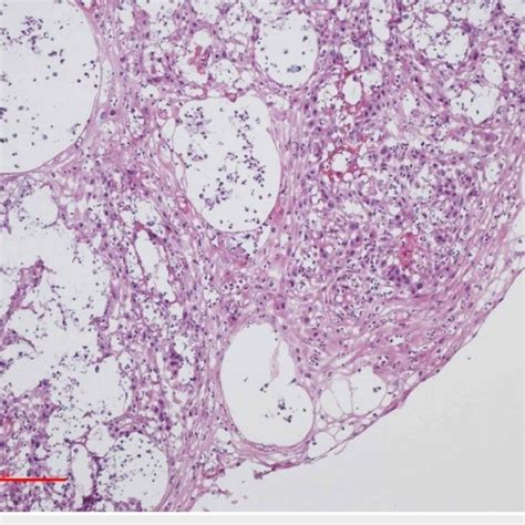 Hematoxylin And Eosin H E Histopathology Of The Left Aryepiglottic