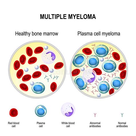 Multiple myeloma. plasma cell myeloma royalty free illustration Poster ...