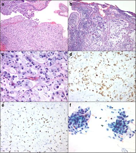 Pathology Of Signet Ring Cell Carcinoma Of The Ampulla Of Vater A