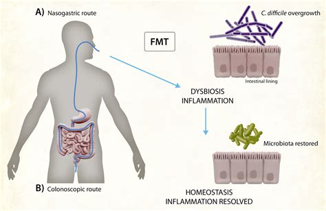 The Gut Microbiota And Inflammatory Noncommunicable Diseases