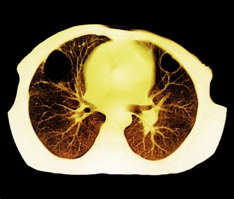 Lung Abscess, Ct Scan Photograph by Zephyr - Pixels