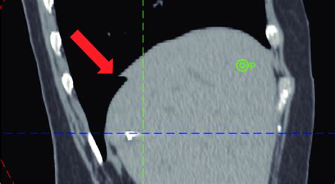 An Example Of Motion Artifacts In 4d Ct Download Scientific Diagram