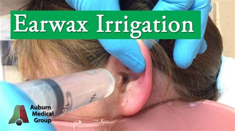 Ear Wax Irrigation Auburn Medical Group Youtube