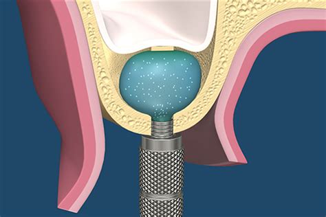 Sinus Grafting And Dental Implants