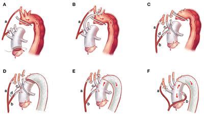 Frontiers Total Arch Replacement With Frozen Elephant Trunk Using A