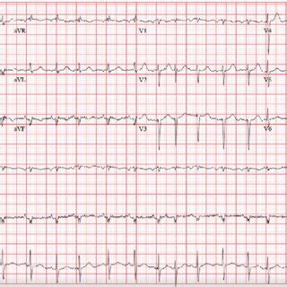 Twelve Lead Electrocardiogram Showing Sinus Tachycardia Occasional