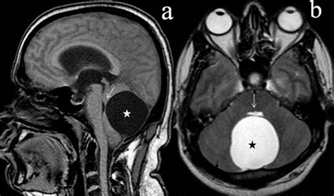 Posterior fossa arachnoid cyst. Sagittal T1W(a) and axial T2W(b) image ...