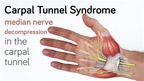 Tratamentul Chirurgical In Sindromul De Tunel Carpian De Ce E Necesar