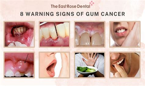 8 Early Symptoms Of Gum Cancer And Treatment Methods