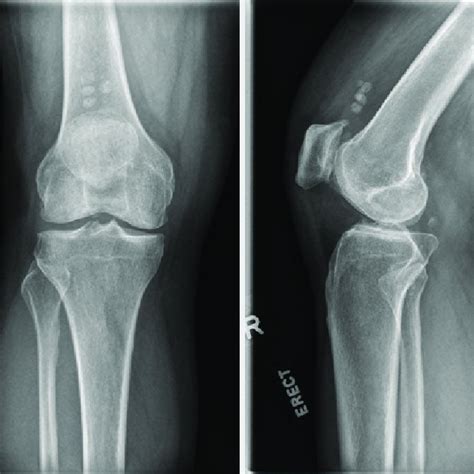 Plain Radiograph Of The Right Knee Anteroposterior A And Lateral B Download Scientific