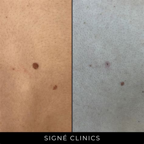 Moedervlek Excisie Dermatologie Signé Clinics Rotterdam