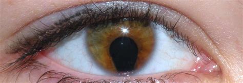 Coloboma O Que Causas E Tratamentos Dispon Veis Lenscope